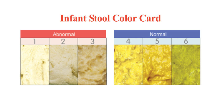 light colored stool liver disease