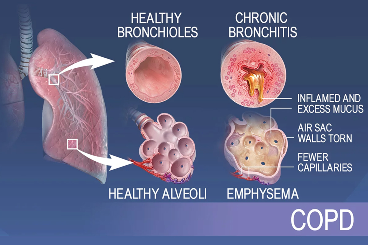 5 Common Lung Disorders And Their Causes Regency Healthcare