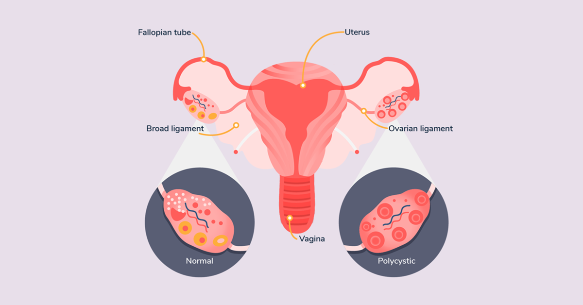 Suffering From PCOS? Here's How You Can Maintain Your Fertility and ...