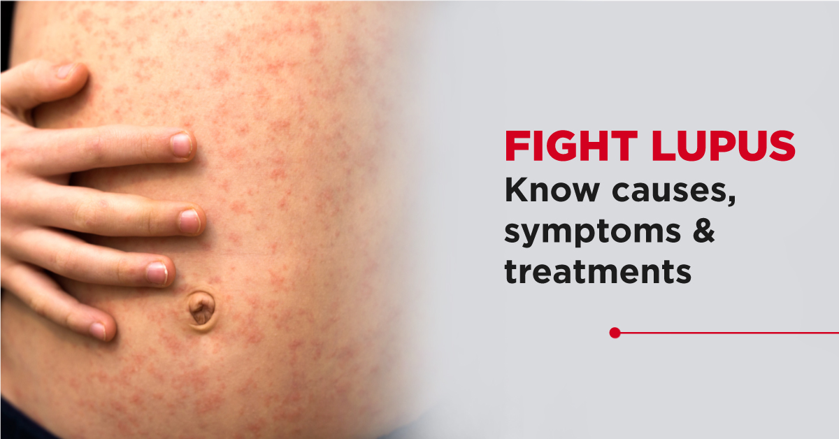 Fight Lupus: Causes,Symptoms & Treatments - Blog - Regency Healthcare Ltd