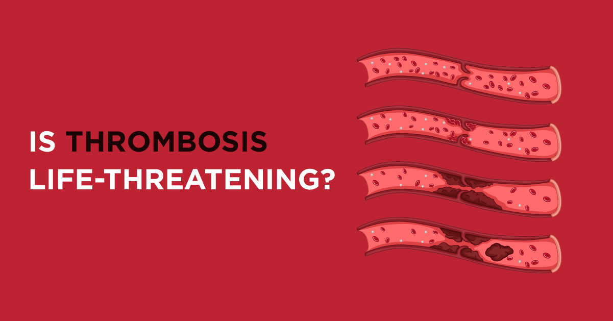 Is Deep Vein Thrombosis Life - Threatening?