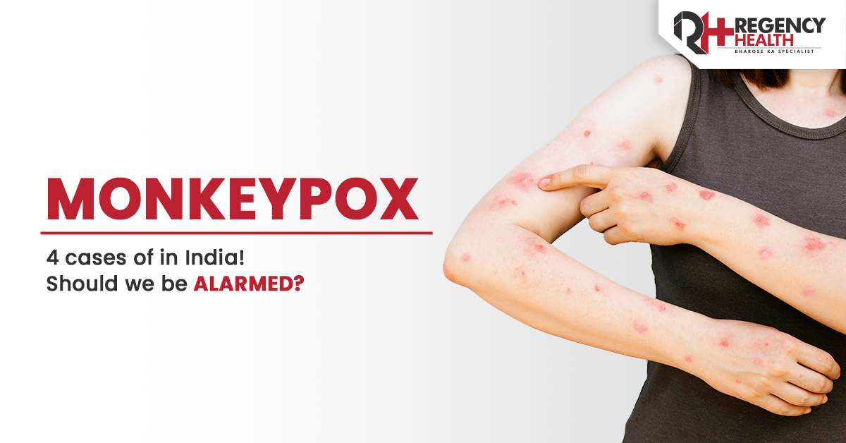 Monkeypox Causes, Symptoms, Treatment & Prevention