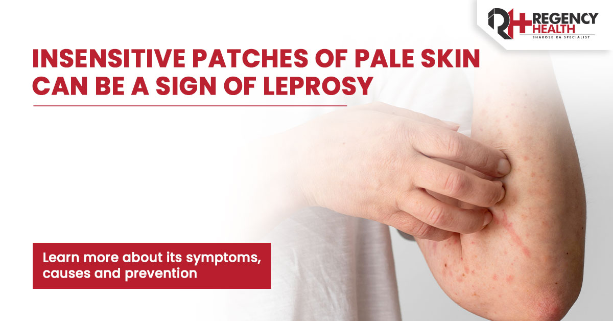 Leprosy (Hansen's Disease): Causes, Symptoms & Treatment