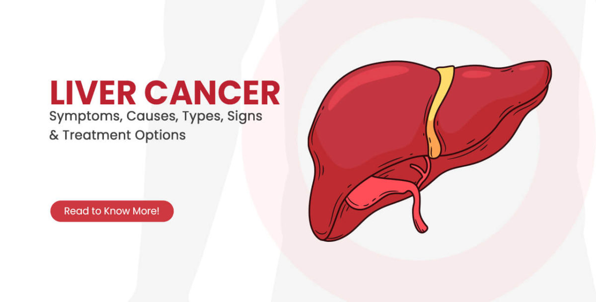 Liver-Cancer-Symptoms-Causes-Types-Signs-and-Treatment-Options-1200x608.jpg